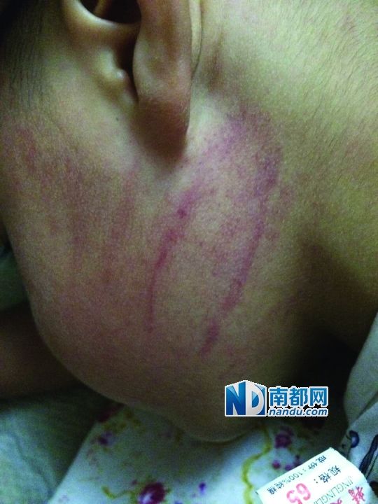 小逸臉上淤痕清晰可見。