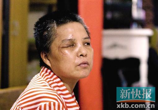 4月初,趙女士遭人搶劫并被打傷,現(xiàn)今右眼失明,頭部被縫100多針。記者 畢志毅/攝