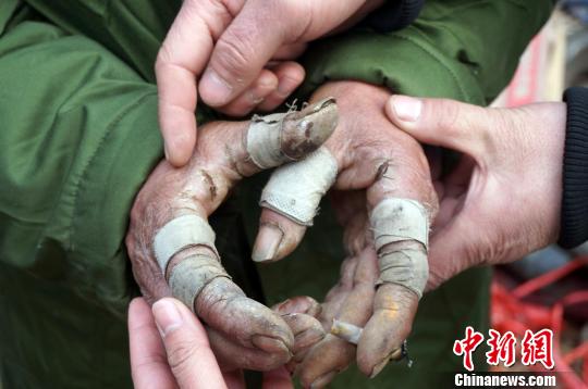 圖為由于常年拾荒，老人雙手布滿傷口。周小云 攝