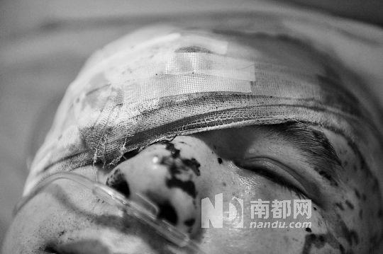 李建新頭部還有被潑硫酸的痕跡，醫(yī)生說被砍傷的右眼已經(jīng)失明。 南都記者 田飛 攝