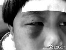 6月2日，網(wǎng)曝渭南市臨渭區(qū)一不滿5歲的女童遭奶奶毆打，眼圈青腫，引起網(wǎng)友關(guān)注，但孩子父母和爺爺均稱是摔倒導(dǎo)致。相關(guān)部門介入調(diào)查發(fā)現(xiàn)確為奶奶毆打所致，鑒于其身體原因已進(jìn)行批評教育。