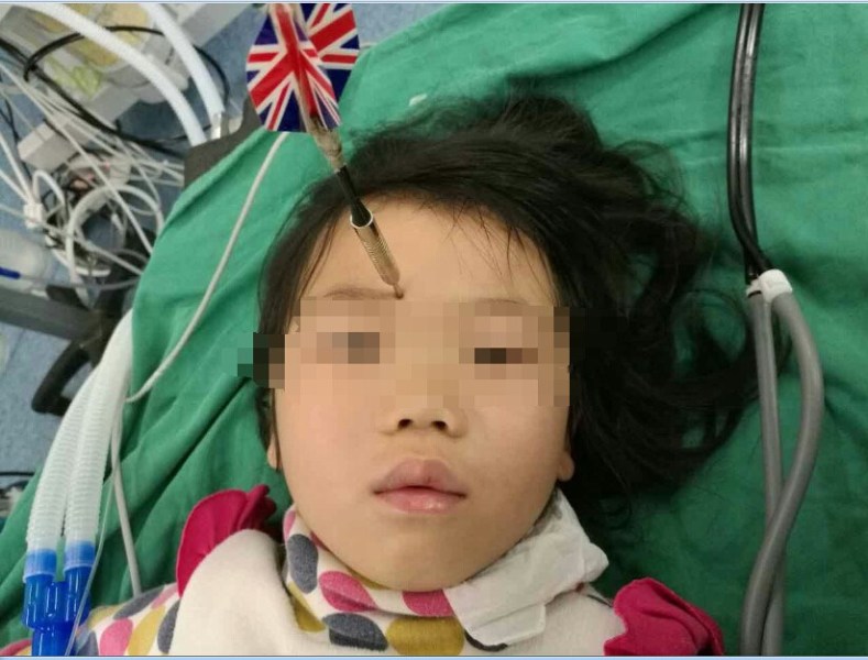 十多公分長的飛鏢穩(wěn)穩(wěn)地 ” 定 ” 在了一名六歲半的女童額頭上，小青一家人凌晨從長順趕到貴醫(yī)附院急診室時，看到如此慘烈的情況，接診醫(yī)生都嚇了一跳。詳細詢問下得知，原來是七歲的哥哥和六歲半的表妹在玩耍時，哥哥不慎將路邊撿來的真飛鏢扎到了妹妹的額頭上。