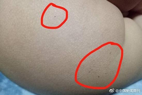 據(jù)多名紅黃藍(lán)(新天地分園)家長(zhǎng)反映，孩子腿部、屁股、腋下出現(xiàn)針眼。
