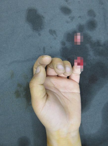 嚇哭！6歲男孩被夾斷手指 罪魁禍?zhǔn)拙故切７? oldsrc=