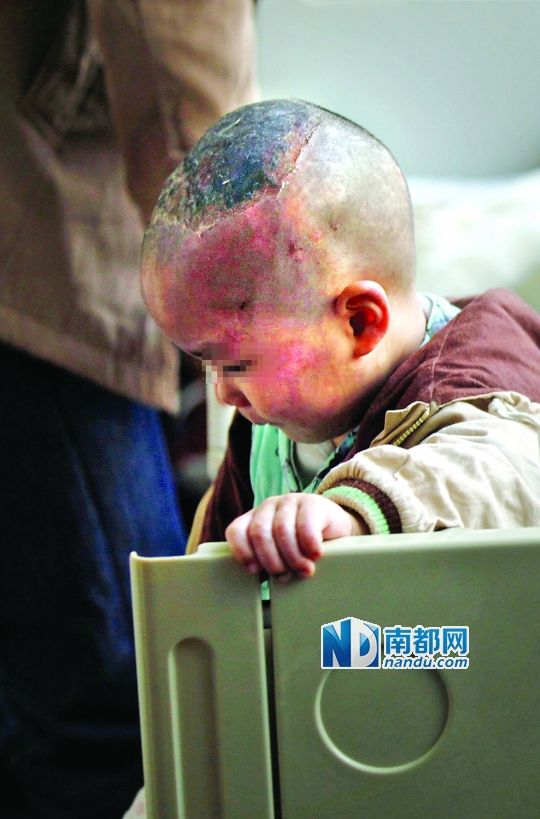 1月8日下午，小寶頭上和臉上都是傷痕。