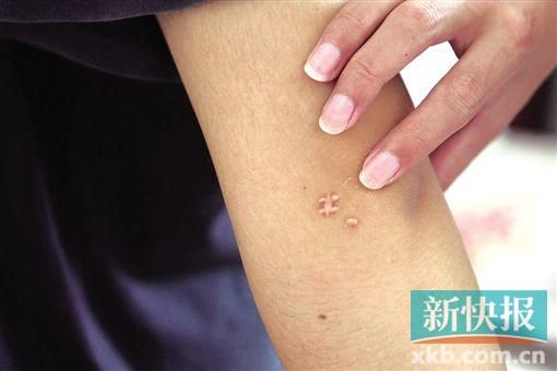 取出針后李星兒手臂留下了傷口。新快報(bào)記者 張國(guó)鋒/攝