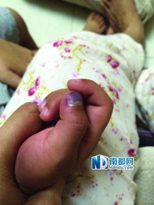 小逸手指被夾傷。