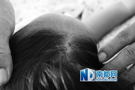 女童頭上被扎的針孔（圓圈處）。賈先生說(shuō)，被扎不到三秒鐘，女兒就昏了。