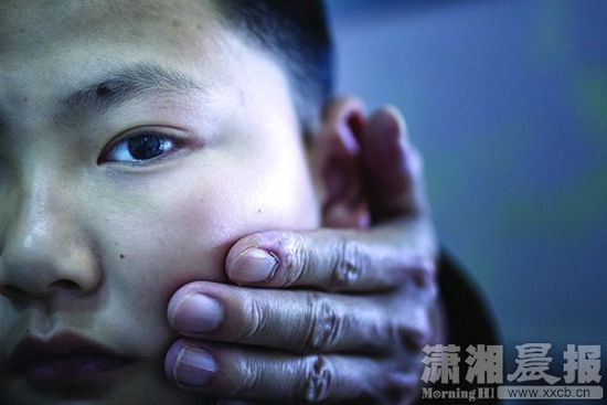 1月13日，小玨的父親心疼地摸著兒子的臉。