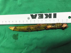 插入男子腦內(nèi)的樹枝。